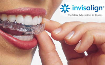 Who Is a Candidate for Invisalign?