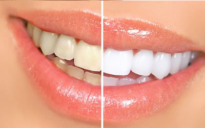 Keeping Your Bright Smile after Teeth Whitening